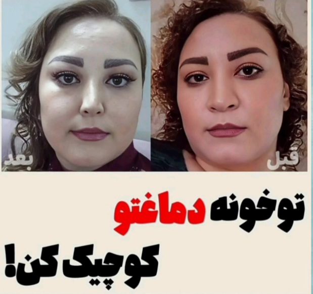 تصویر کوچک کننده بینی در ۲۰ روز